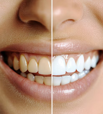Blanqueamiento dental antes y después