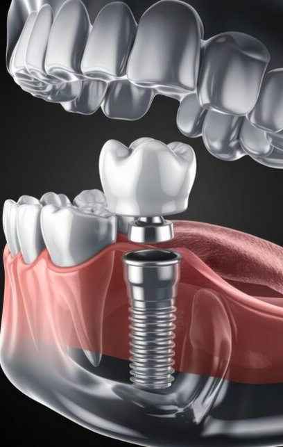 Implante dental